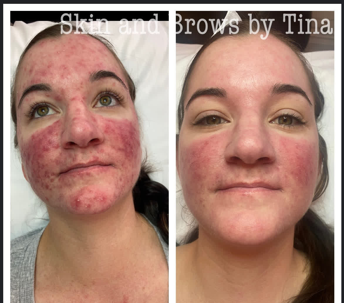 Acne & redness