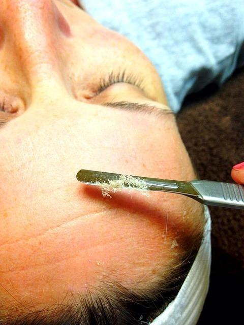 Dermaplaning